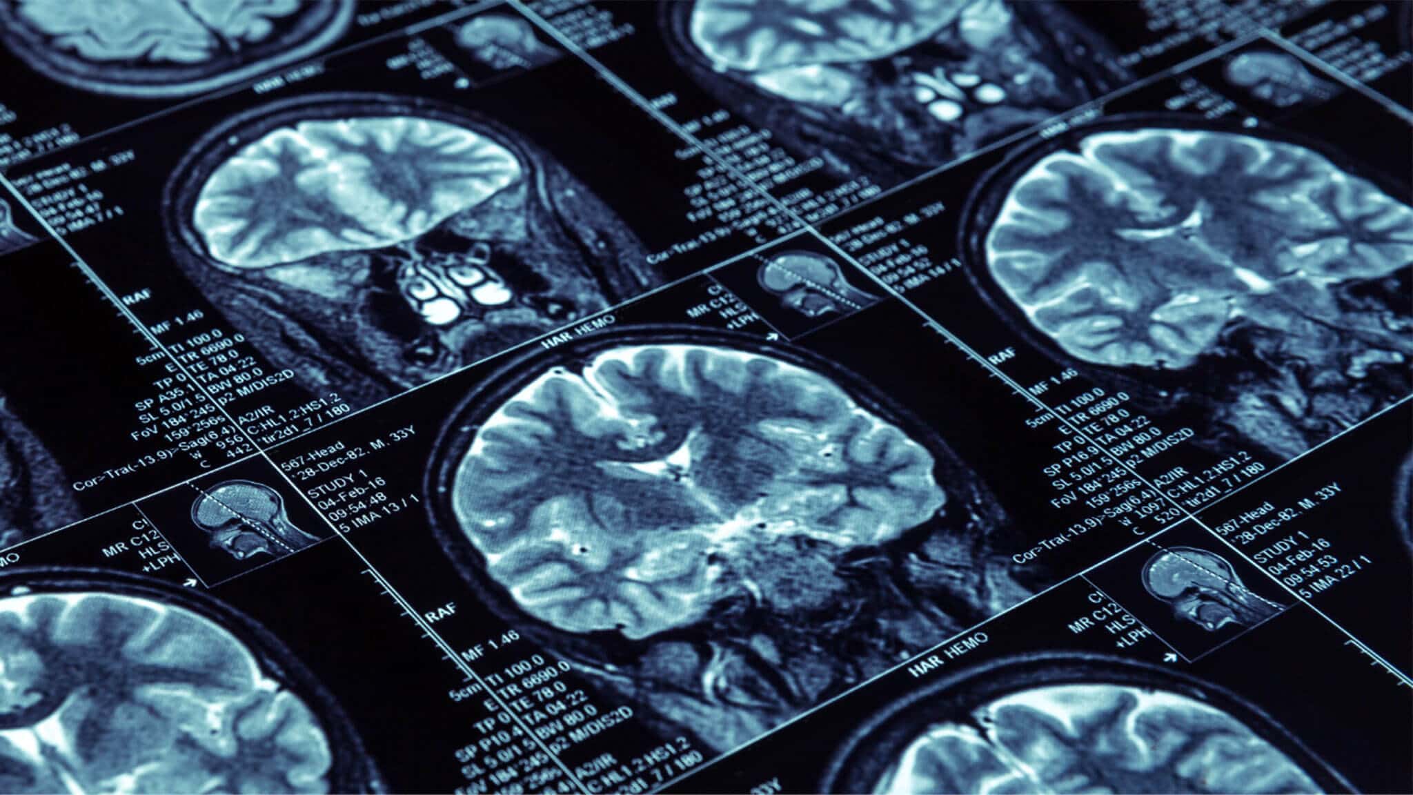 Multiple medical brain scans on dark background